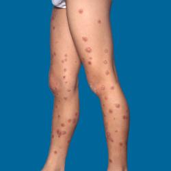 Example of psoriasis